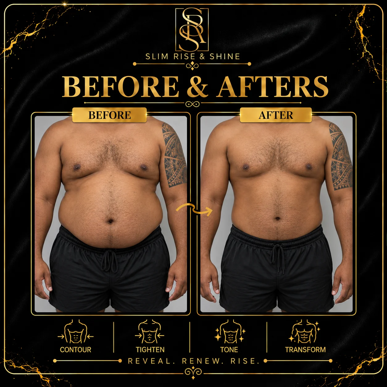Slim Rise and Shine male contouring case 01