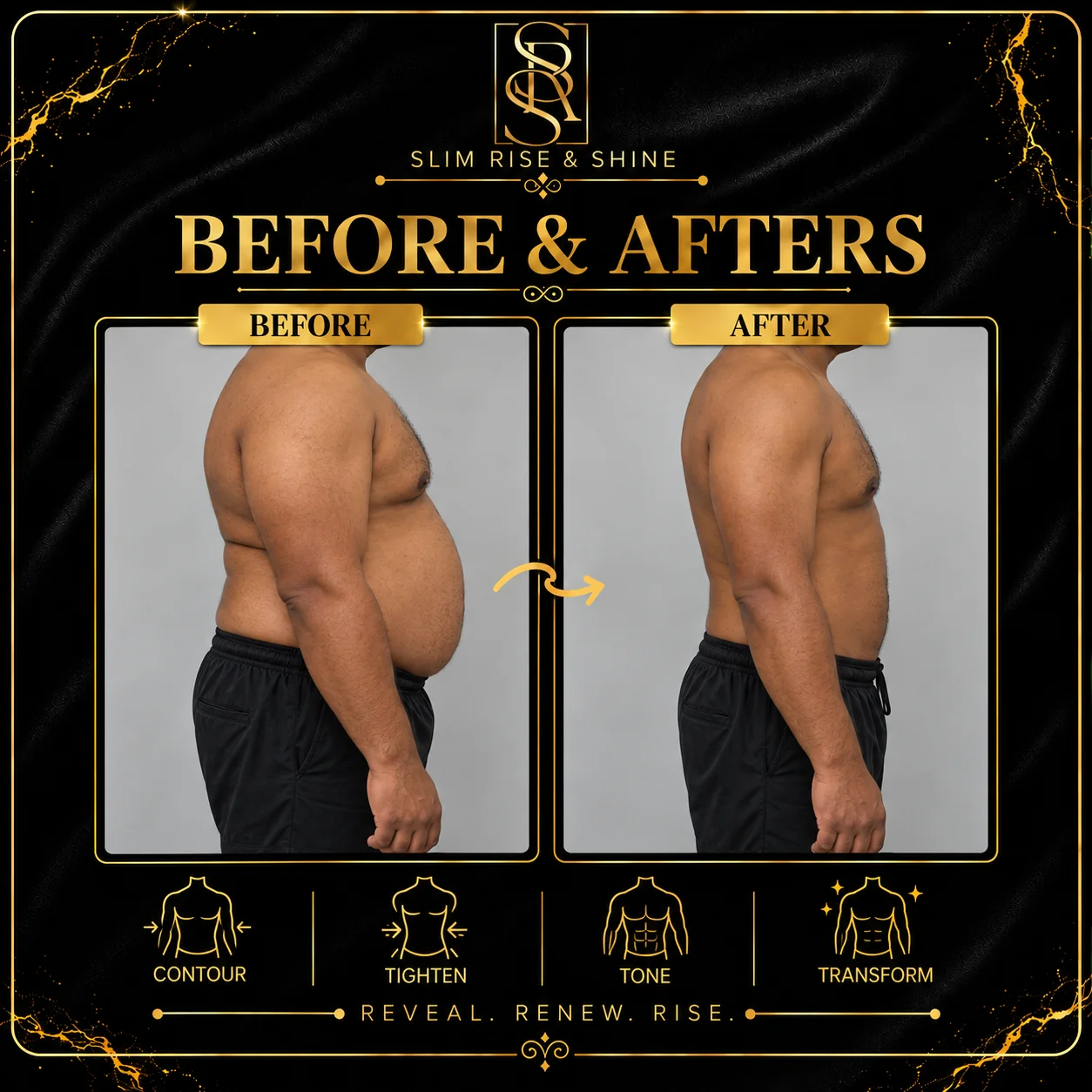 Slim Rise and Shine male contouring case 02